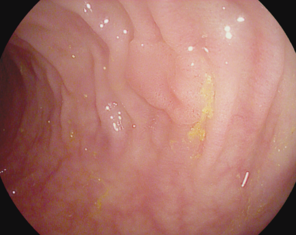 Tubular adenoma with low-grade dysplasia